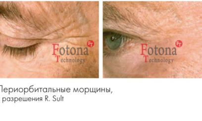 Фотона Глаза 10